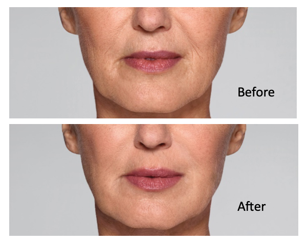restylane-lift-before-after-at-results-med-spa