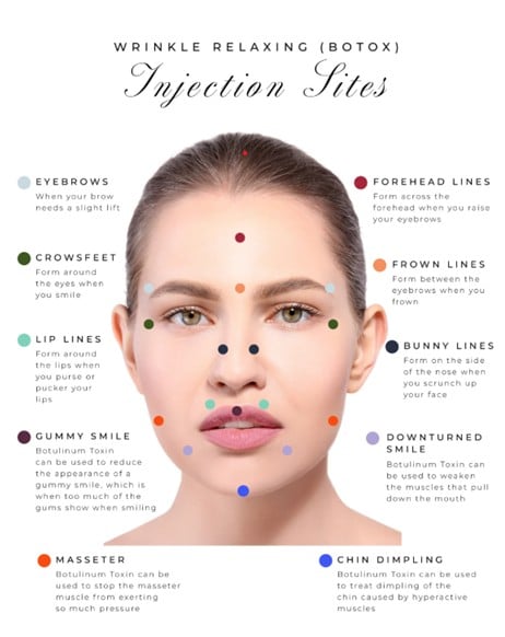 Botox injection sites for neurotoxin treatment in Buda, Texas