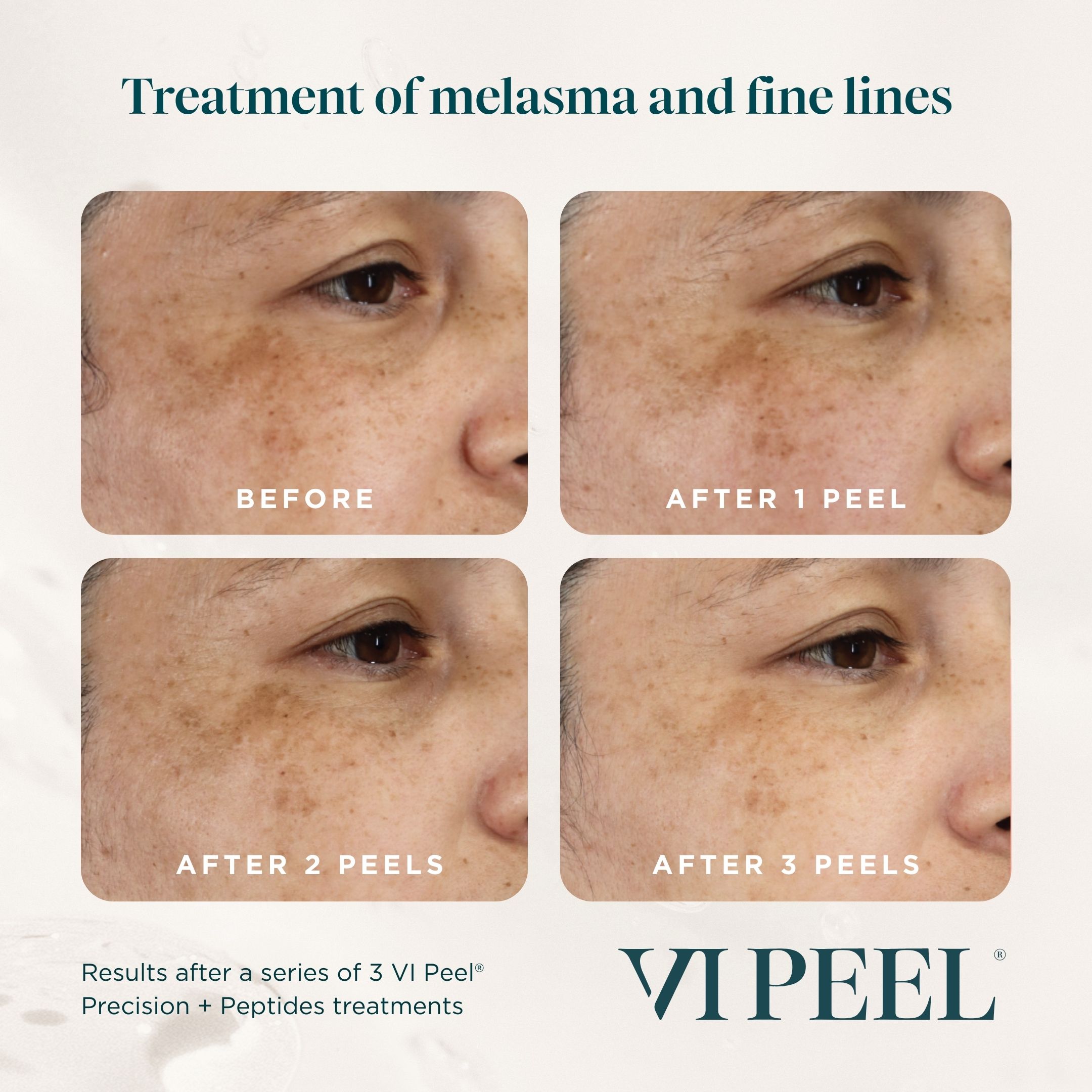 VI Peels with Peptides before and after used at Results Weight Loss and Med Spa Buda, Texas