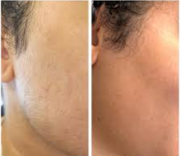 Before and after laser hair removal in Buda and Kyle