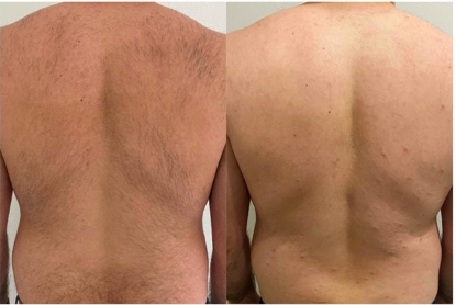 Mens Before and After Laser hair removal in Buda and Kyle, Texas. 