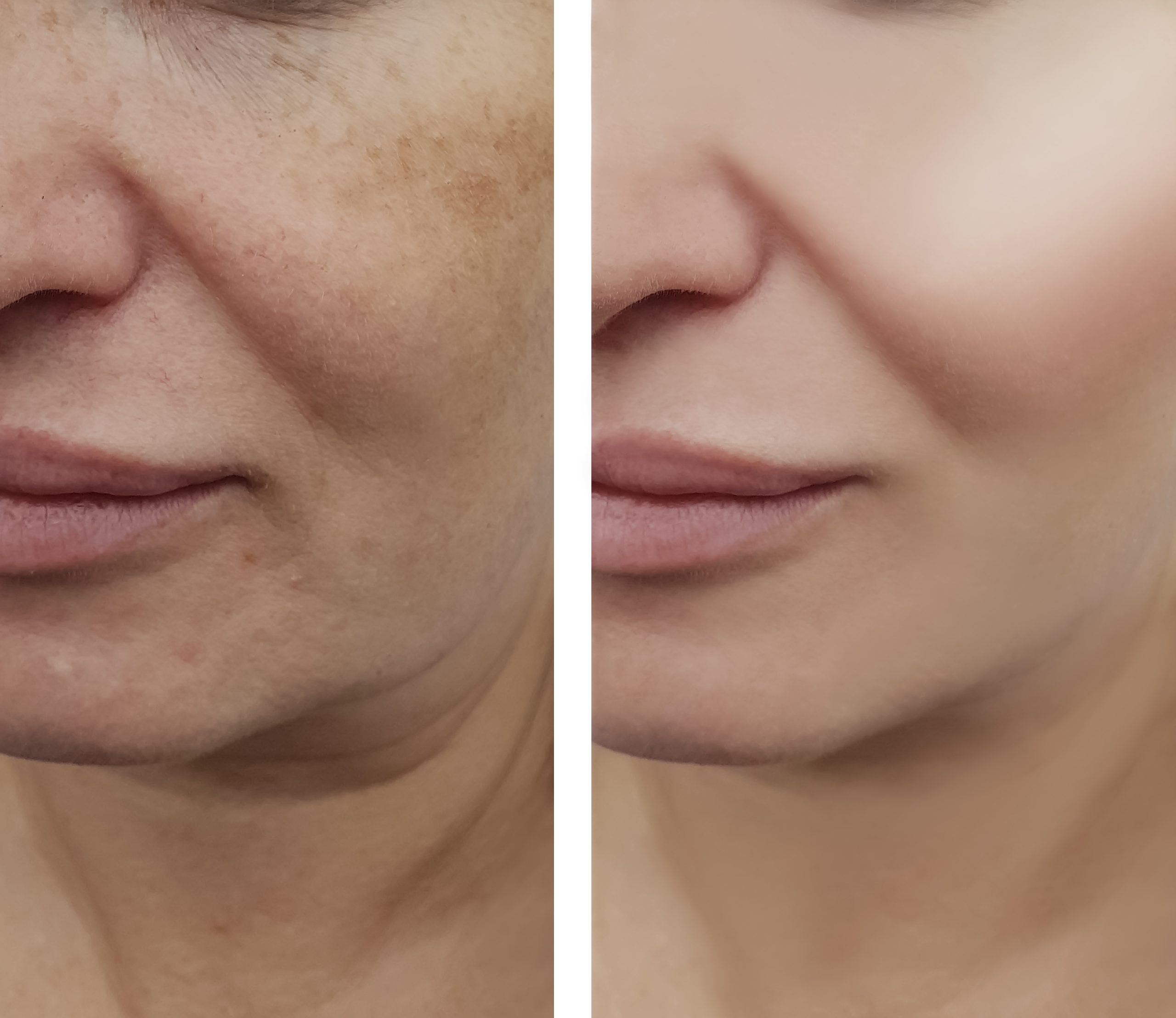 Before and after a Chemical Peel to lighten hyperpigmentation.
