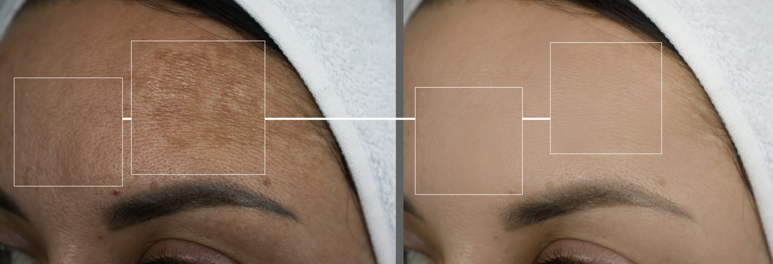 Melasma causes dark patches triggered by hormonal changes and sun exposure can be treated by chemical peel.