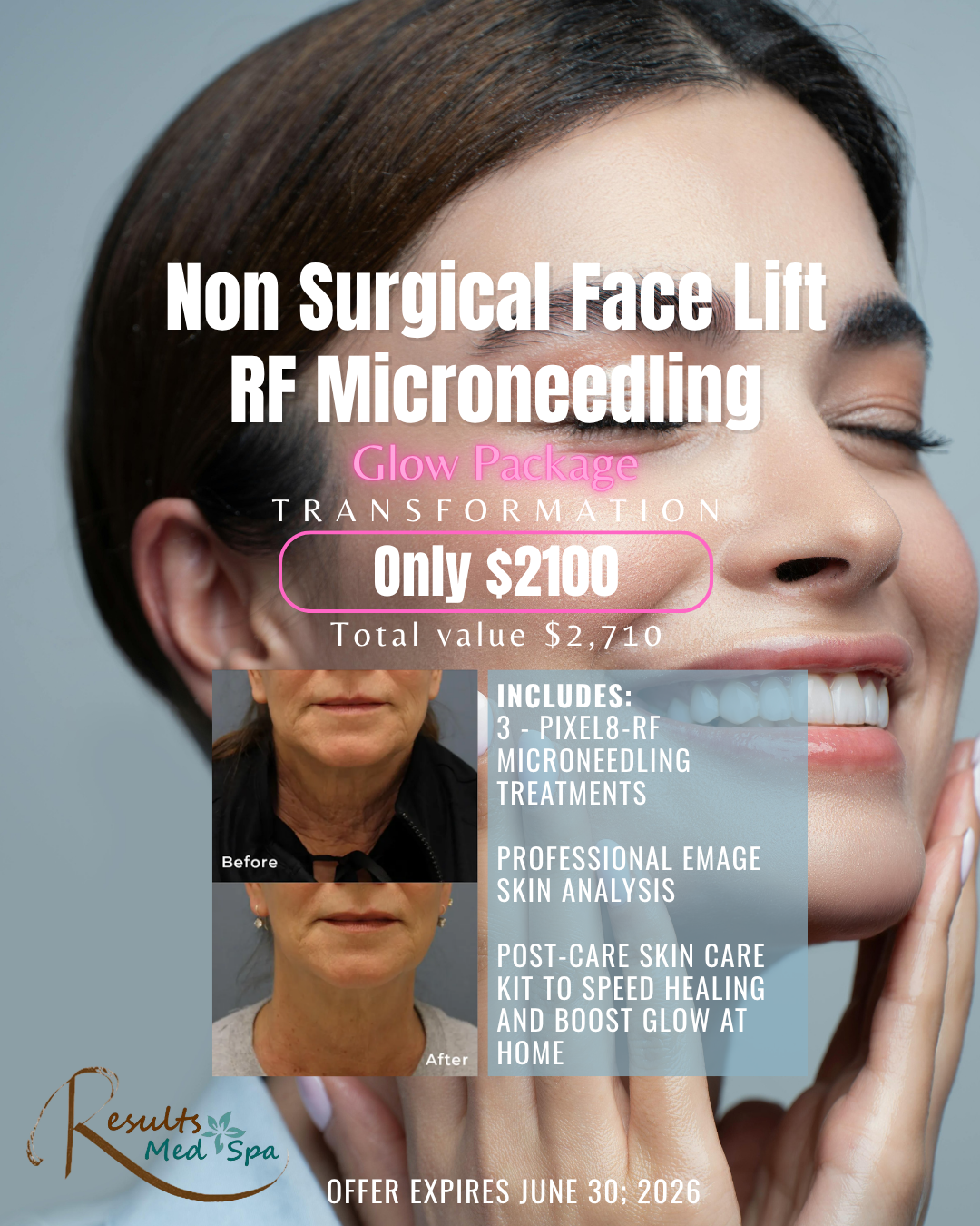 Best Radio Frequency Micro Needling