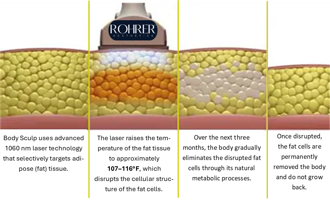 BodySculp treatment diagram at Results Weight Loss and med spa.