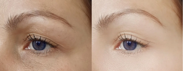 Before and After laser treatments at a Med Spa