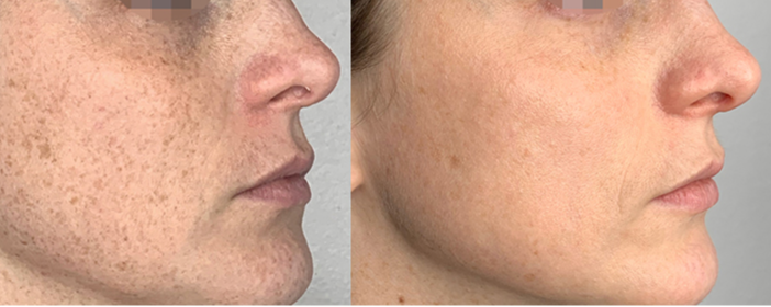 Before and After laser treatments at a Med Spa