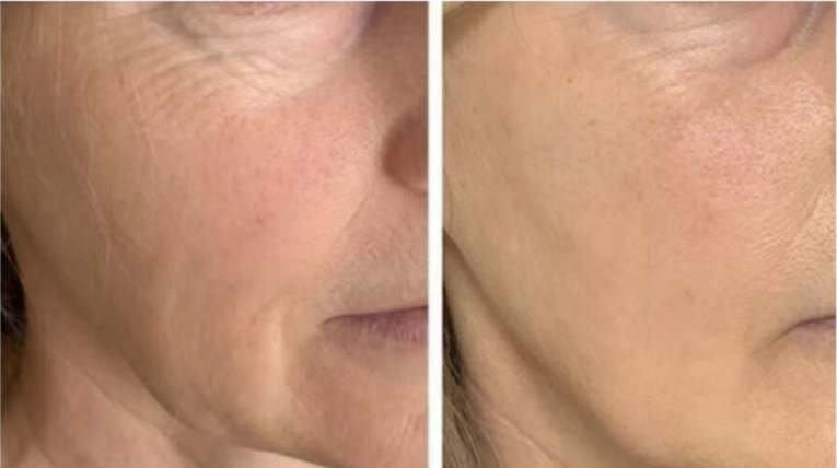 Before and After laser treatments at a Med Spa