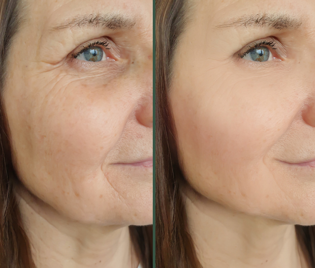Botox/ Dysport Treatment before and after